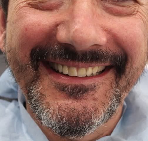 Home Paciente sonriendo con prótesis de cerámica sobre implantes
