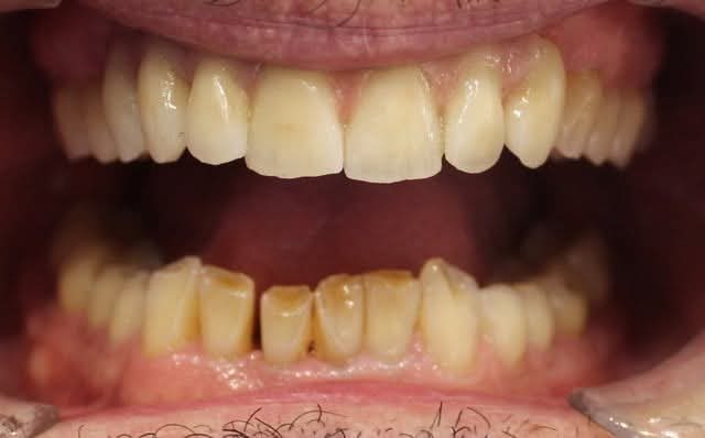 Home Caso clínico de cerámica sobre implantes en boca