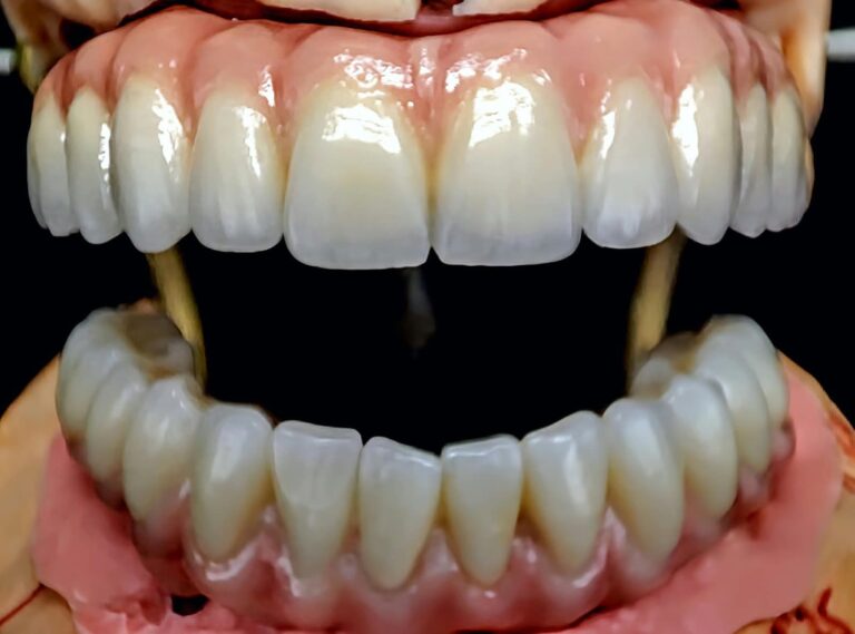Home Prótesis de cerámica sobre implantes superior e inferior, laboratorio dental en Gipuzkoa