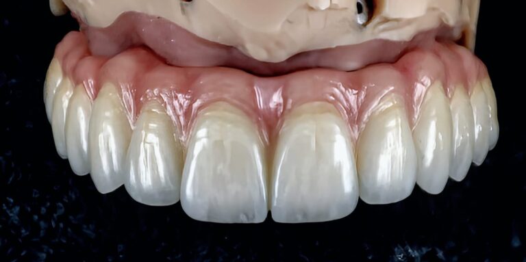 Home Arcada superior de cerámica sobre implantes con encía cerámica