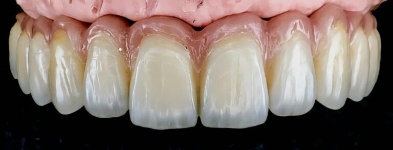 Home Detalle frontal de prótesis de cerámica sobre implantes