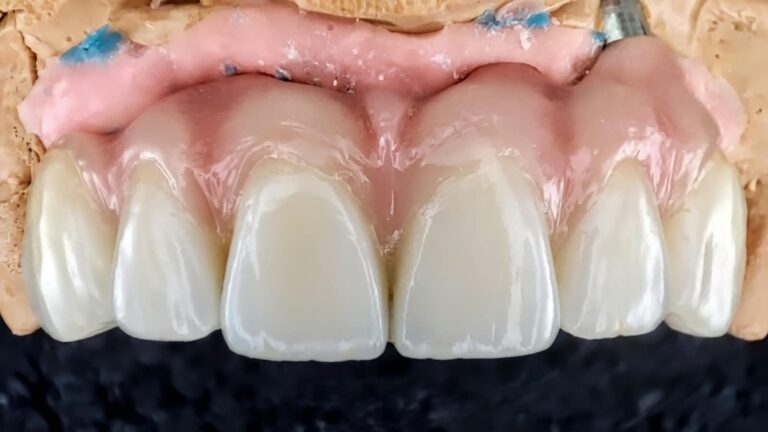 Home Cerámica sobre implantes en modelo de trabajo