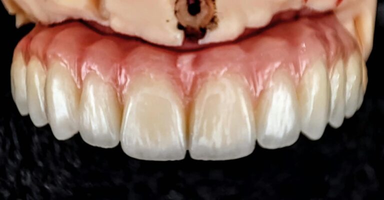 Home Rehabilitación completa de cerámica sobre implantes atornillada
