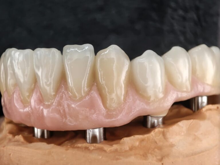 Home Prótesis híbrida de resina sobre implantes inferior