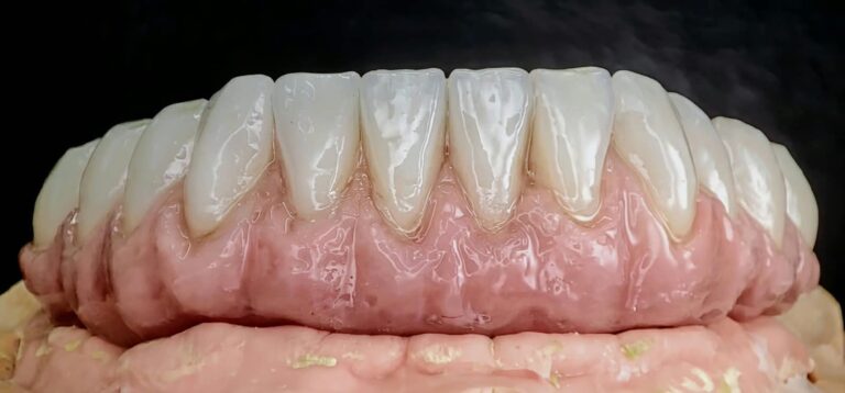 Home Prótesis híbrida de resina sobre implantes con encía caracterizada
