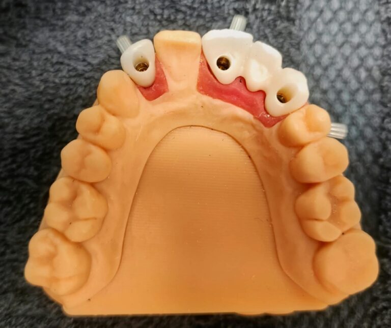 Home Modelo impreso digital con estructuras CAD-CAM sobre implantes