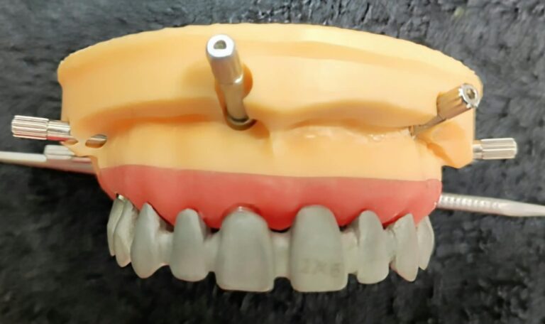 Home Estructura CAD-CAM sobre modelo impreso con implantes