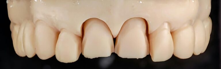 Home Modelo impreso digital de prótesis dental